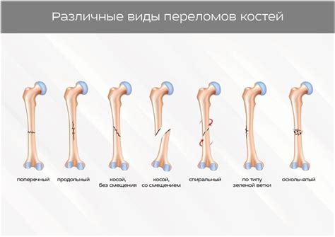 Косой перелом: причины и симптомы