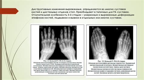 Костно-деструктивные изменения: основная информация