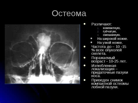 Костные отростки и пазухи