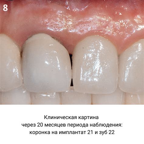 Краткое описание фенестрации