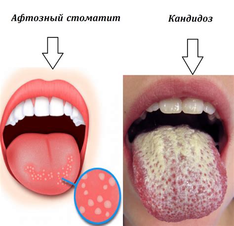 Кровь во рту: физиологические механизмы и чувство вкуса