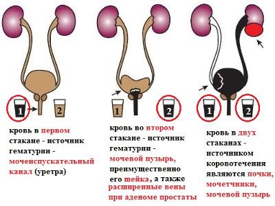 Кровь в моче