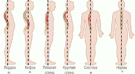 К чему может привести нарушение нормы физиологического поясничного лордоза?