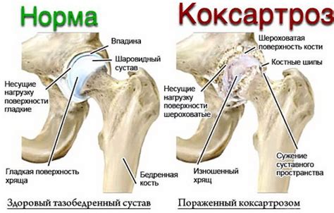 Левосторонний коксартроз 3 степени