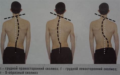 Левосторонний сколиоз грудного отдела: симптомы, причины и лечение