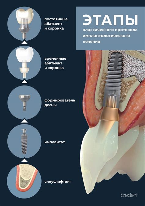 Легирование и медицинские имплантаты