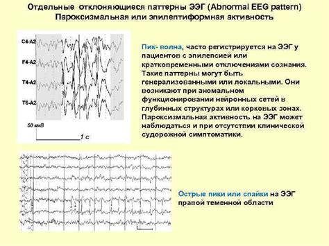 Легкие диффузные изменения корковой ритмики