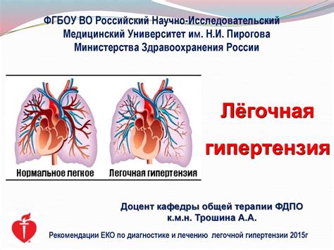 Легочная гипертензия: понятие и особенности