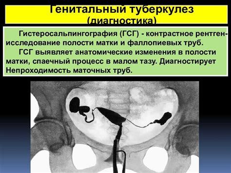 Лечение ГСГ маточных труб