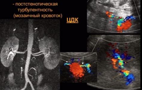 Лечение аберрантной левой почечной артерии