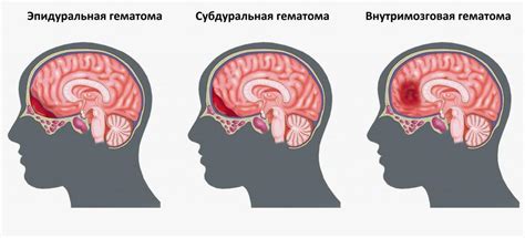 Лечение гематомы головы