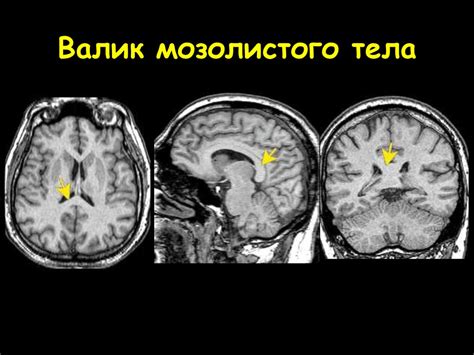 Лечение гипогенезии мозолистого тела