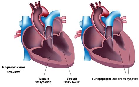 Лечение гипотрофии левого желудочка сердца