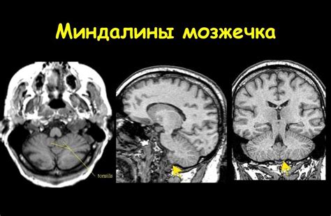 Лечение заостренных миндалин мозжечка