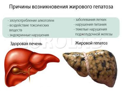 Лечение застойной печени