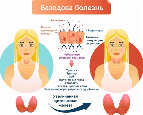 Лечение зоба: основные методы