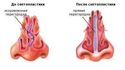 Лечение изъязвления носовой перегородки