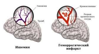 Лечение и последствия энцефалопатии