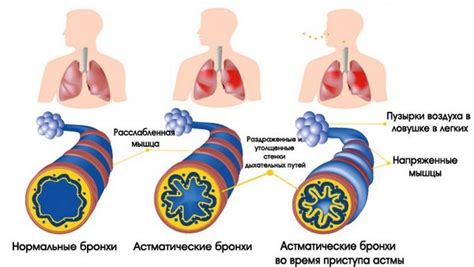 Лечение и предотвращение нехватки воздуха