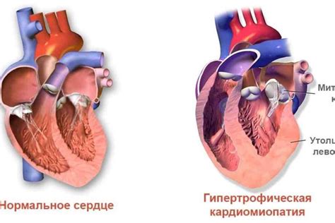 Лечение и профилактика дефектов митрального клапана противофаза