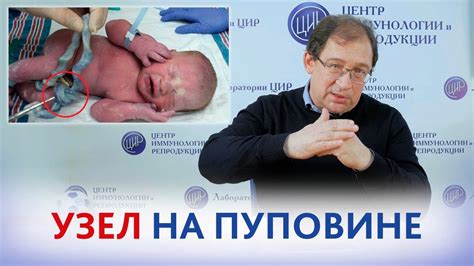 Лечение и профилактика обвития пуповиной