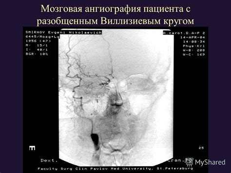 Лечение и управление Виллизиевым кругом