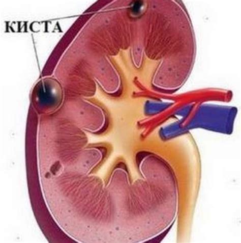 Лечение кисты левой почки
