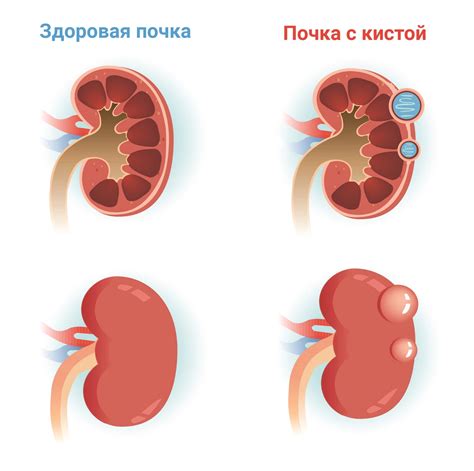 Лечение кисты паренхимы правой почки