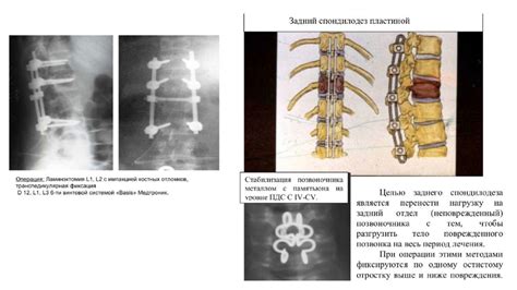 Лечение компрессионного перелома ноги