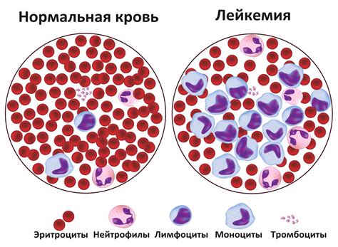 Лечение кристаллизации крови