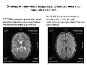 Лечение мелкоочаговых изменений вещества мозга