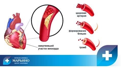 Лечение миокарда утолщен