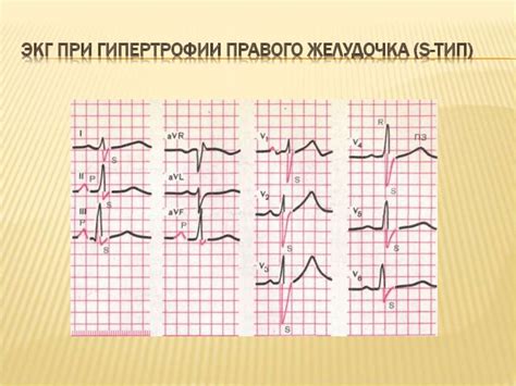 Лечение нарушений левого предсердия на ЭКГ: основные подходы