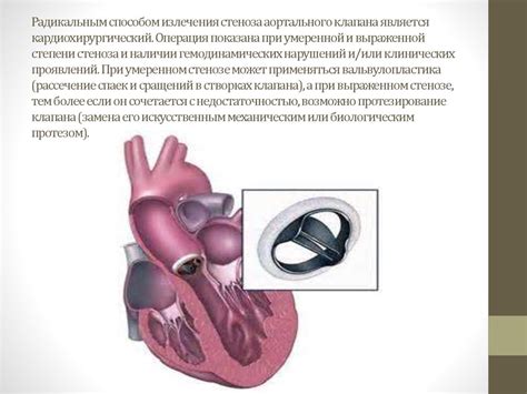 Лечение недостаточности клапанов МПВ