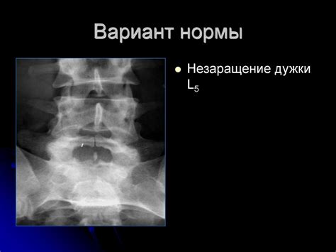 Лечение незаращения задней дужки S1