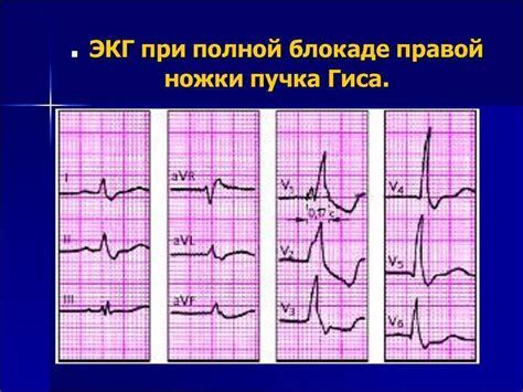 Лечение неполной блокады правой ножки гипса