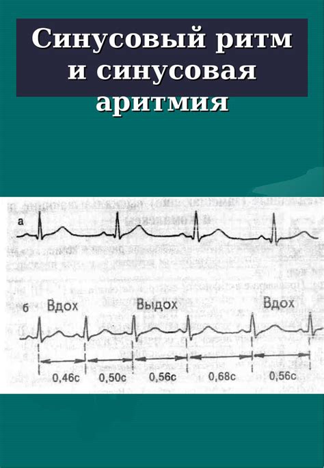 Лечение нерегулярного синусового ритма