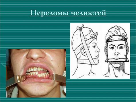 Лечение неспособности открыть челюсть до конца