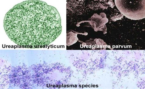 Лечение обнаружения Ureaplasma spp