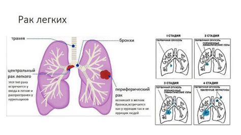 Лечение опущенного легкого