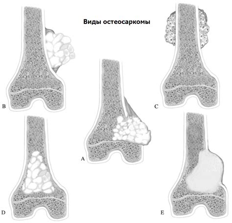 Лечение остеосаркомы