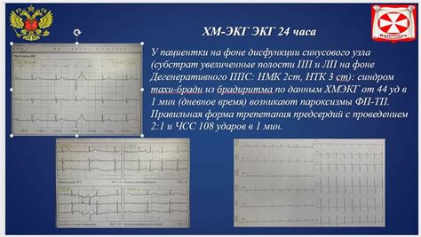 Лечение пароксизмальной формы фибрилляции предсердий