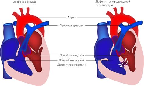 Лечение перегородок сердца у ребенка