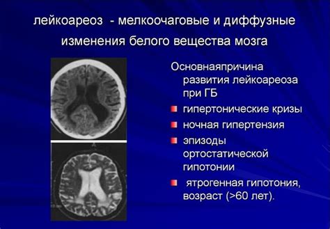 Лечение перивентрикулярного лейкоареоза