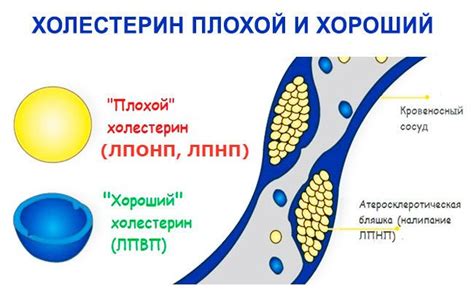 Лечение повышенного уровня липопротеина низкой плотности