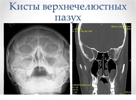 Лечение полипа верхнечелюстной пазухи