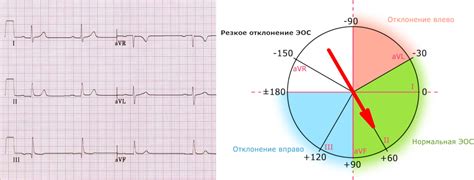 Лечение полувертикального положения электрической оси сердца