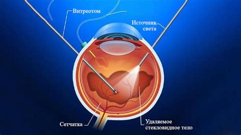 Лечение порванной сетчатки глаза