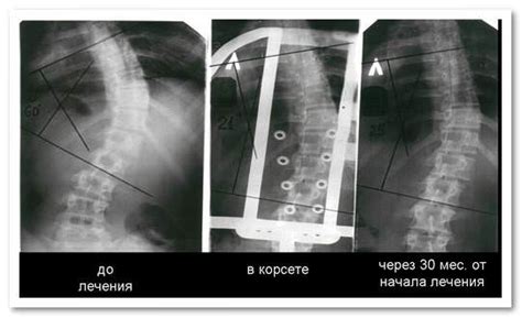 Лечение правостороннего сколиоза грудного отдела позвоночника