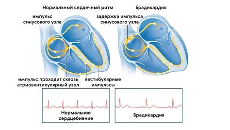 Лечение приглушенного сердцебиения